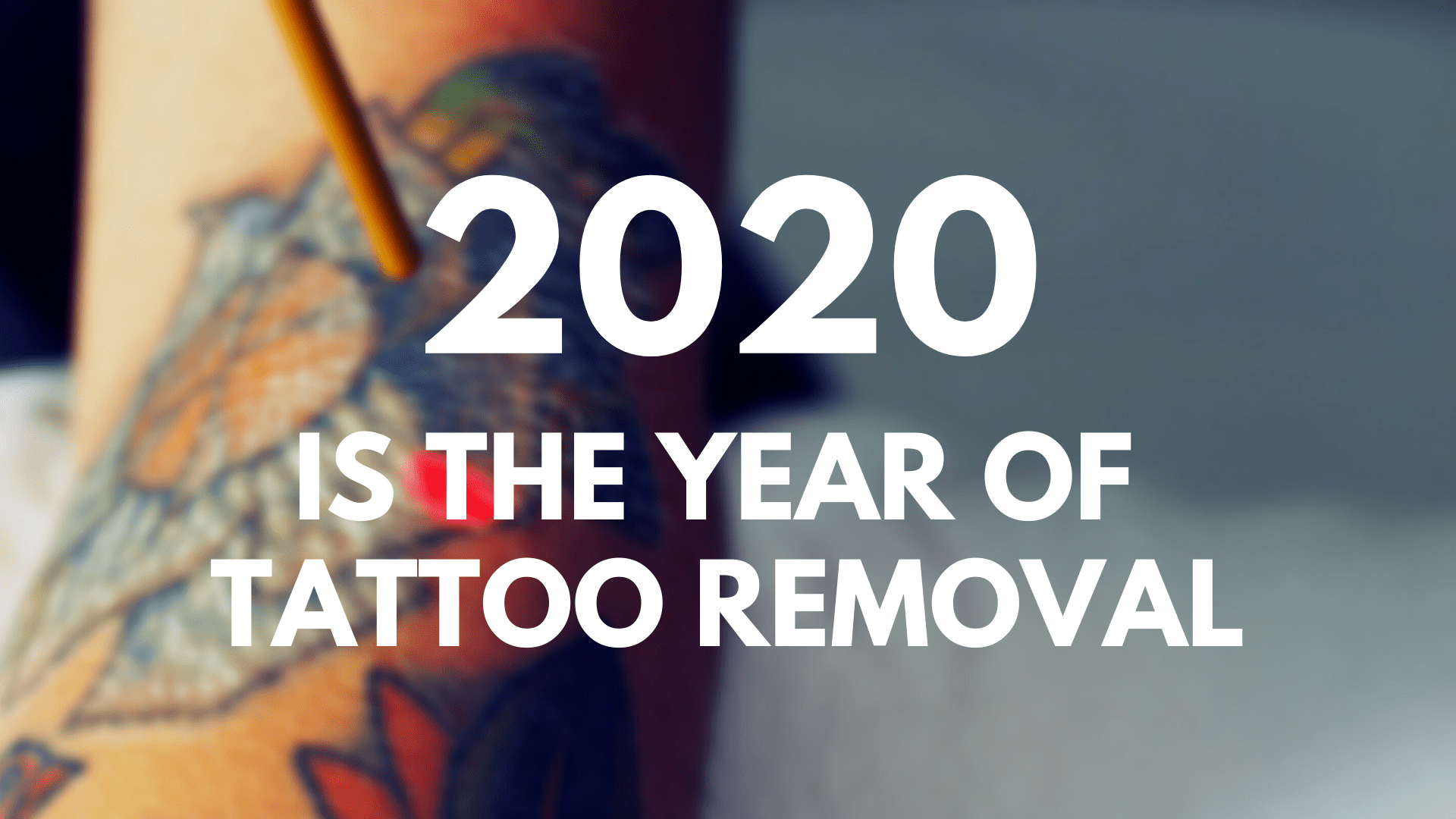 Laser Tattoo Removal Proves to be a Continuing Trend in 2020