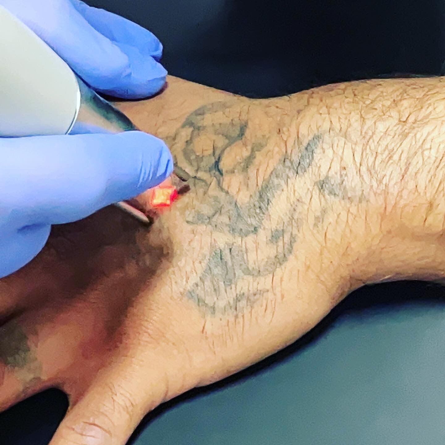 75756315-18AA-48BE-9214-3C727279340C lasertattooremoval